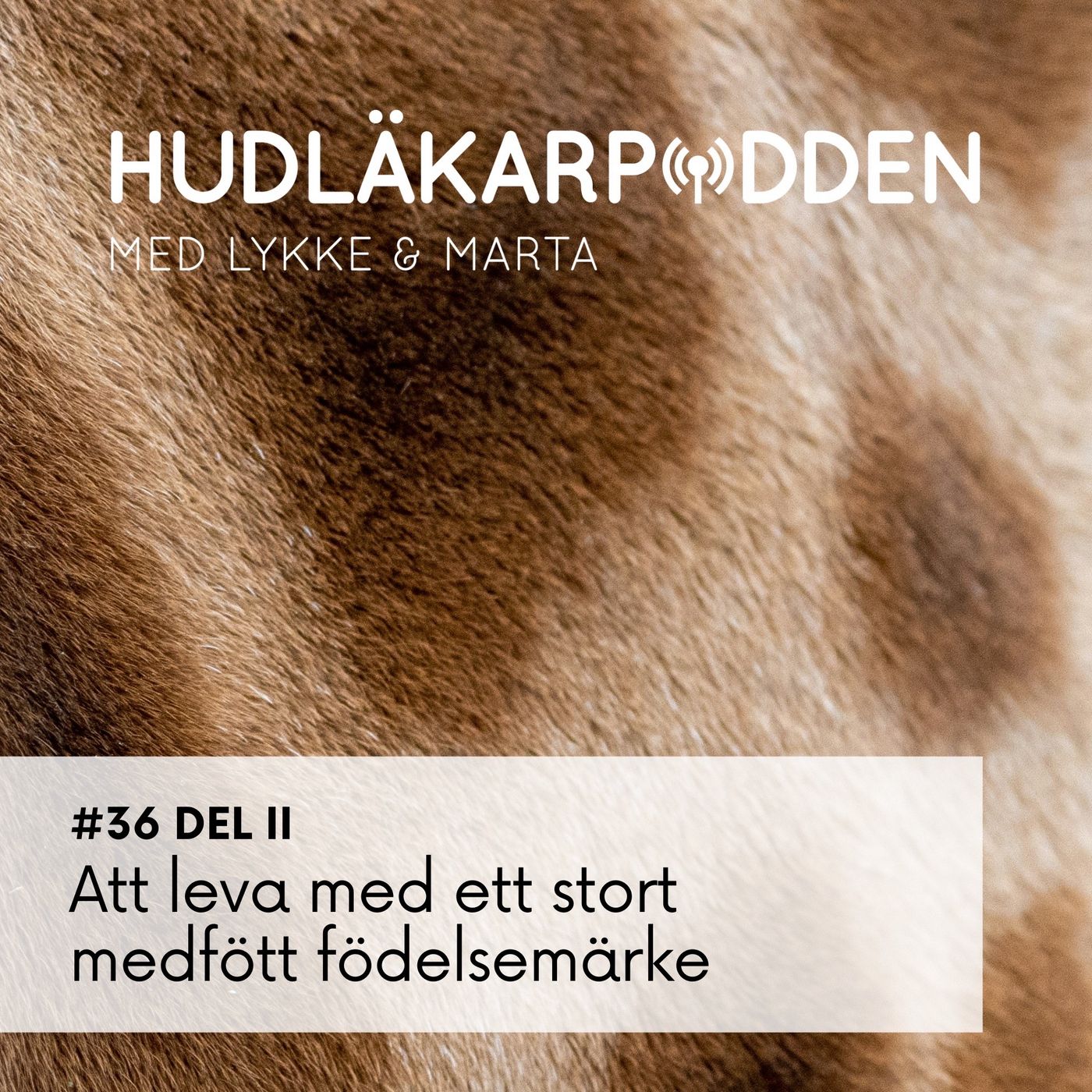 #36 del 2 - Att leva med ett stort medfött födelsemärke 